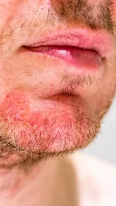 Itchy Beard Rash